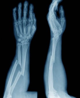 Plate and Screw Fixation of the Arm Bones by OrangeCountySurgeons.org  (2)